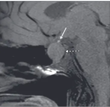 Figura 17. Ponderação em T1 com saturação de gordura em plano sagital mos- mos-trando neuro-hipóise ectópica (seta contínua), secundariamente à presença  de macroadenoma (seta tracejada).