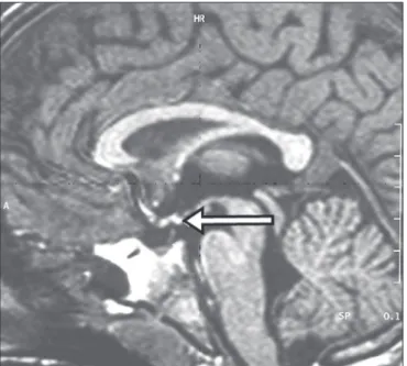 Figura 18.  Ponderação em T1 no plano sagital identiicando neuro-hipóise ec- ec-tópica (seta) em paciente com déicit idiopático de hormônio de crescimento.
