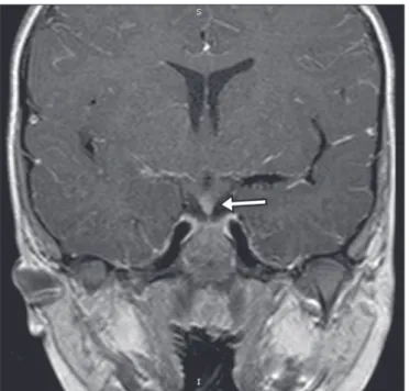 Figure 15. Hemangioma. Dynamic contrast-enhanced coronal T1-weighted MRI sequences showing initial peripheral contrast enhancement with subsequent  centripetal illing.