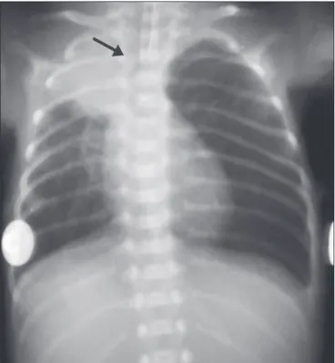 Figura 1.  Radiograia de RN com 29 semanas de idade gestacional e 745 g  ao nascer apresentando atelectasia completa do pulmão esquerdo decorrente  de intubação seletiva da cânula endotraqueal no brônquio-fonte direito (seta).