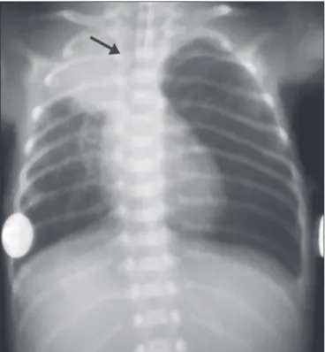 Figure 1. Chest X-ray of a neonate born at 29 weeks of gestation with a birth  weight of 745 g, showing complete atelectasis of the left lung resulting from  selective intubation, the distal end of the endotracheal tube being located in  the right bronchus