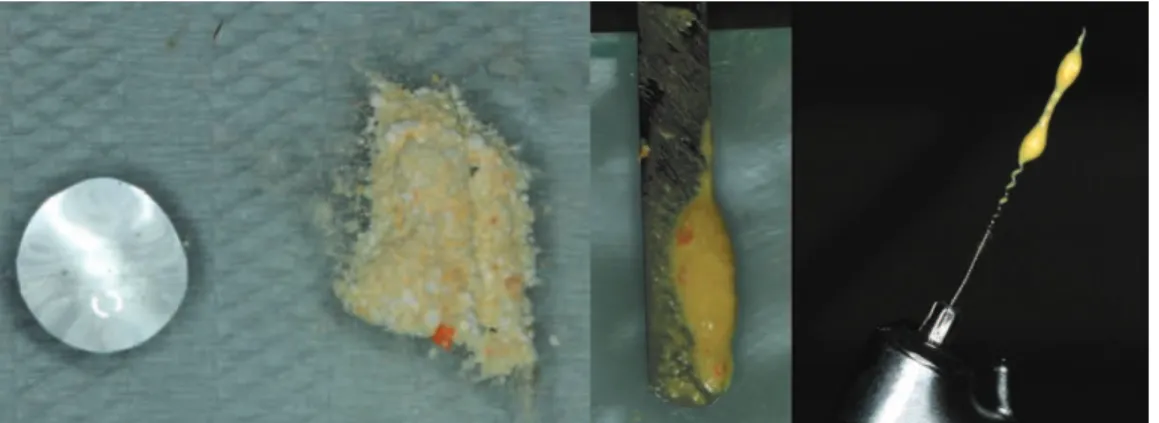 Figure 1.  Images showing triple antibiotic paste consistence and insertion.
