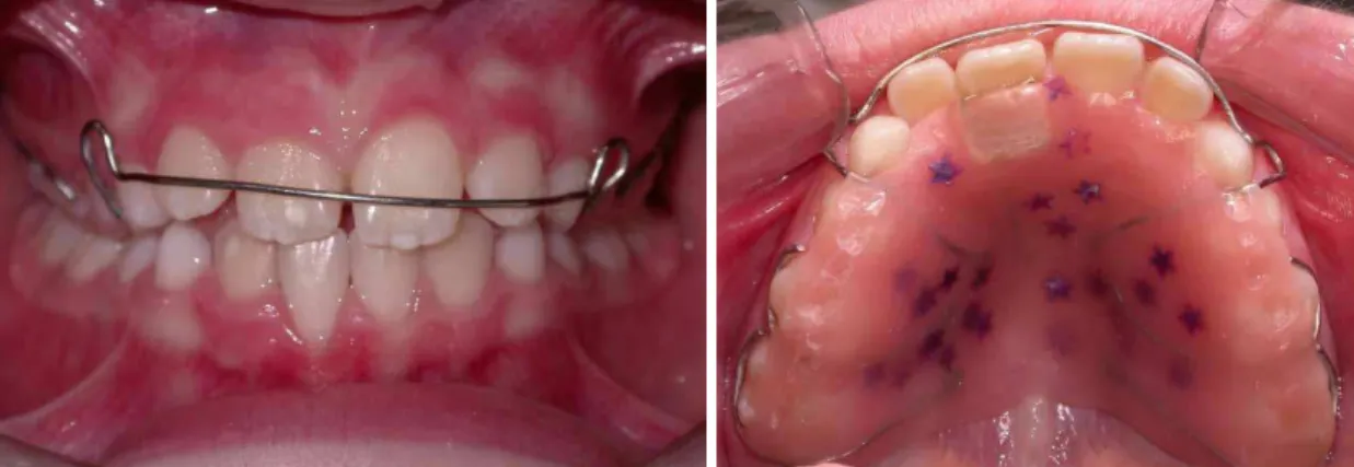Figure 2.  Removable appliance with inger spring used to correct anterior crossbite.