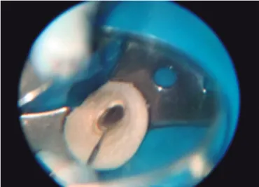 Figure 2. Operating microscope visualization (8x magniication).