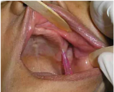 Figure 2.  Immediate postoperative period. Observe the arrow pointing to the adi- adi-pose tissue in position.