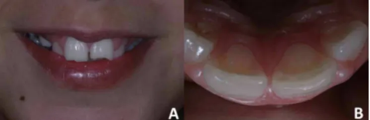 Figure 2.  Acid etching of the fractured teeth with 37% phosphoric acid (A). Ap- Ap-plication of the Adper™ Single Bond Plus Adhesive (B), followed by  light-curing (C).