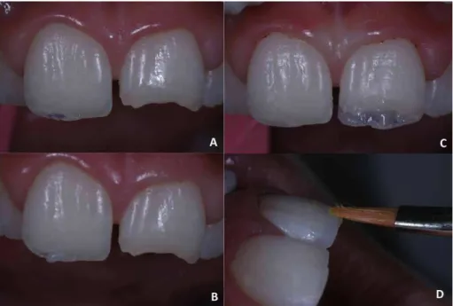 Figure 4.  Finishing procedure performed using the Sof-Lex™ Finishing and Polishing System (A and B) and polishing procedure using a felt disc and diamond paste (C).