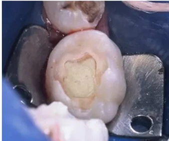 Figure 1.  Initial radiographic examination (tooth 85). Figure 3.  MTA applied on the remaining pulp tissue.