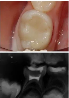 Figure 4.  Clinical and radiographic aspect of tooth 85 after 30 days.