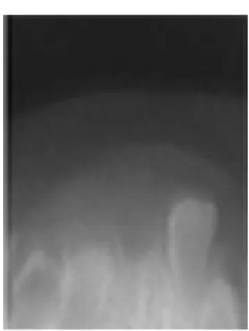 Figure 2. Radiographic characteristic of the lesion Note the tendency toward  premature eruption of tooth 71.