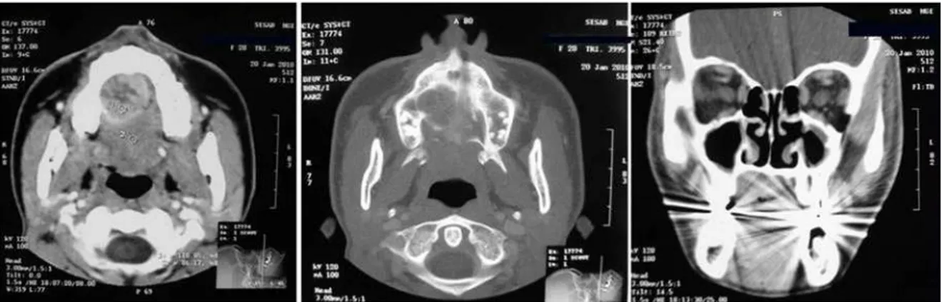 Figure 3.  Clinical trans-operative appearance, demonstrating the complete removal  of the lesion.