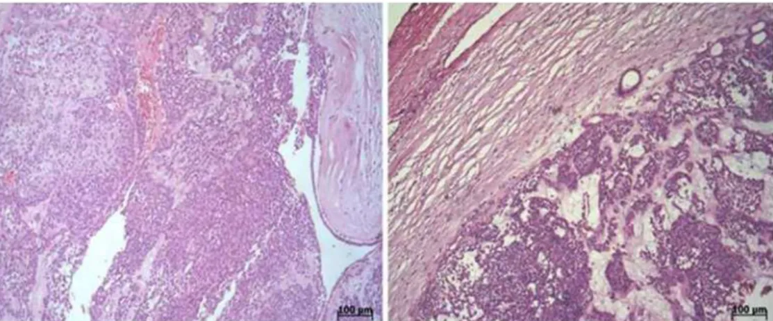 Figure 4.  Microscopic view of the pleomorphic adenoma.