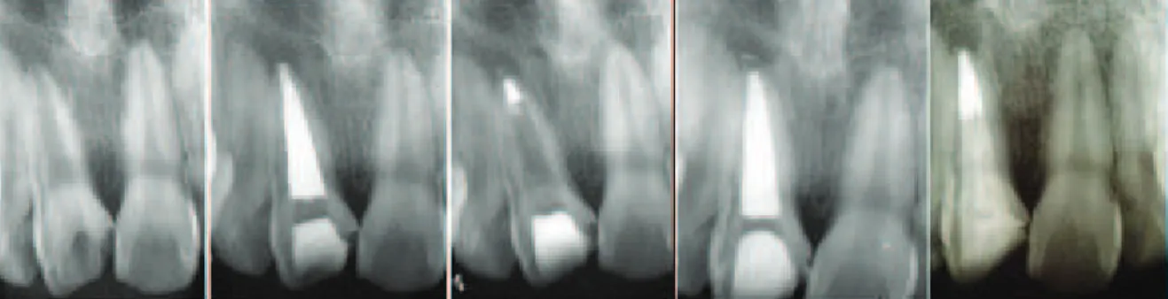 Figure 1. a) initial radiograph; b) root canal dressing with calcium hydroxide; c) MTA plug; d) canal obturation; e) 6-month proservation.