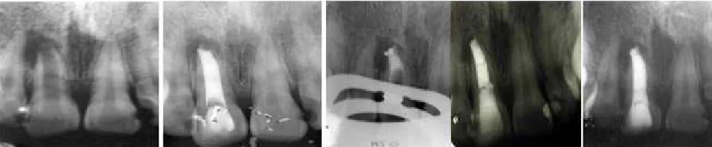 Figure 2. a) initial radiograph; b) root canal dressing with calcium hydroxide; c) MTA plug; d) canal obturation; e) 10-month proservation.