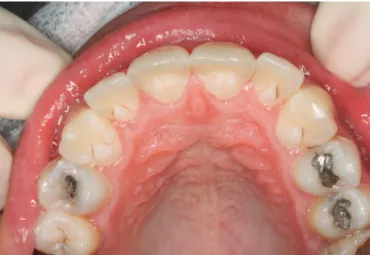 Figure  2.  Panoramic  radiograph  showing  the  talon  cusps  on  the  six  maxillary anterior teeth