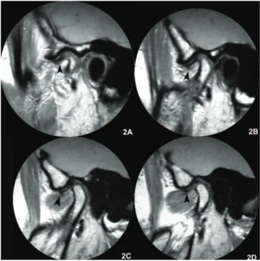 Figure 2.  Parasagittal  images,  closed-mouth,  left  side.  The  same  situation described for the right side is found here (arrows).