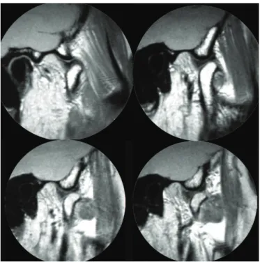 Figure 3.  Open-mouth images, right side, showing normal relationship  between  the  disk  and  the  bony  components  and  normal  condylar excursion.