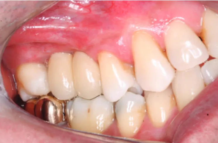 Figure 3. Clinical try-in of ultraconservative ixed partial denture.
