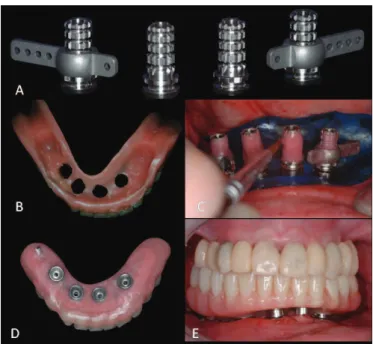 Figure 2.  (A) Acetate matrix fabricated from the diagnostic wax-up for fabrication  of  the  temporary  denture  after  placement  of  the  osseointegratable  implants