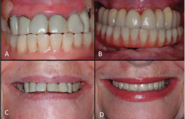 Figure 4.  (A) Customized and cast UCLA type abutments in position; (B) Occlusal  view of the metal infrastructure of the sectioned metal ceramic denture; 