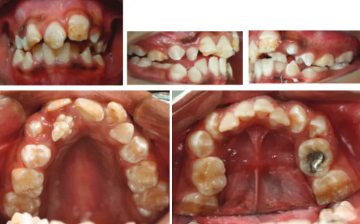 Figure 2. Initial aspect of case, intraoral photographs.