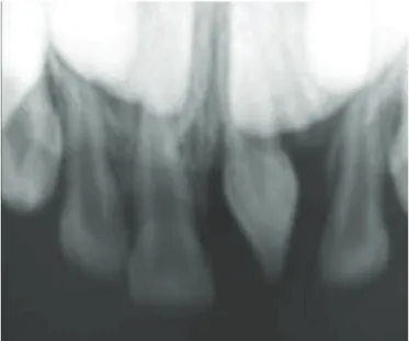 Figure 1.  Initial  clinical  aspect:  supernumerary  peg-shaped  tooth  in  the  anterior  maxillary region.