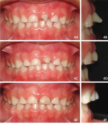 Figure 5.  Diagnostic wax-up (A and B) and creation of the putty index of the incisal  position  using  the  addition  silicone  Express  XT ®   (3M,  Espe,  Sumaré,  Brazil), which guides the professional during the restorative stage (C)