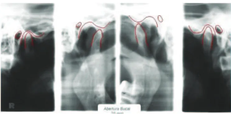 Figure 5. TMJ Planigraphy.
