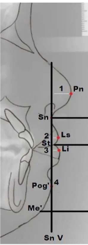 Figure 1. Cephalogram with demarcation of the variables analyzed.