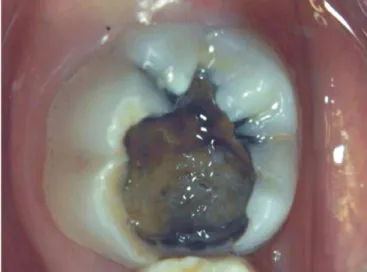 Figure 1. Deep caries lesion in the left mandibular permanent first molar with large  accumulations of cariogenic biomasses.