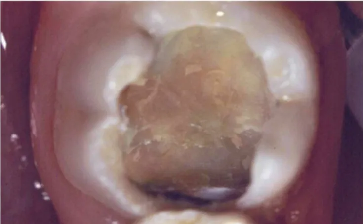 Figure 3. Appearance of dentin of the left mandibular permanent first molar  immediately after incomplete removal of carious dentin.