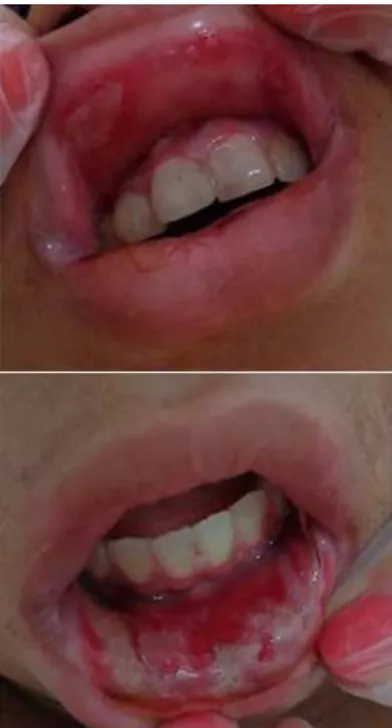 Figure 1. Severe oral mucositis lesions affecting the skin and mucosa of the upper  and lower lips.