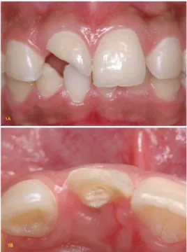 Figure 1. Initial patient condition. A) Oblique fracture of tooth 11, in the mesiodistal  direction; B) Palatal view showing inlammation of the gingival margin  due to invasion of the biological width.