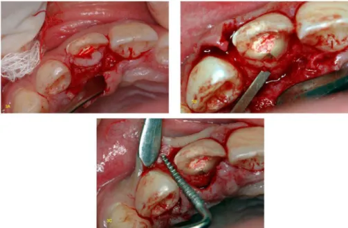 Figure 3. A) Incision and retraction of the lap; B) Palatal osteotomy with chisel, removing 1 mm of bone crest; C) Smoothing of the bone crest using a ile.