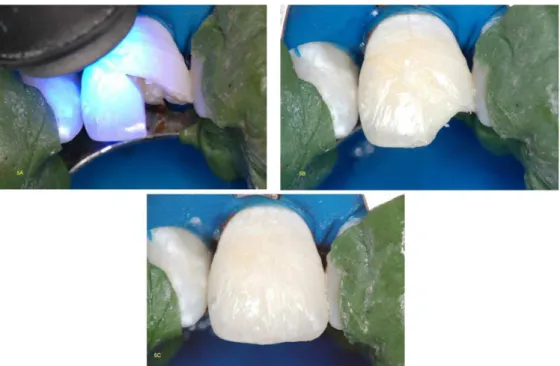 Figure 5. A) Reattachment and photopolymerization of the second fragment; B-D) Restoration of lost tooth structure with micro-hybrid dentin-resin, enamel and translucent  resin