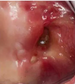 Figure 3. Curettage performed for removal of necrotic and inlammatory tissue.  Figure 4