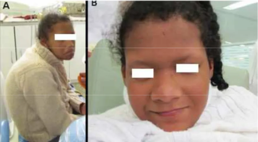 Figure 3. Intraoral Photography lower arch: A) before dental treatment. Nova Friburgo, RJ, Brazil, 2012.B) after dental treatment