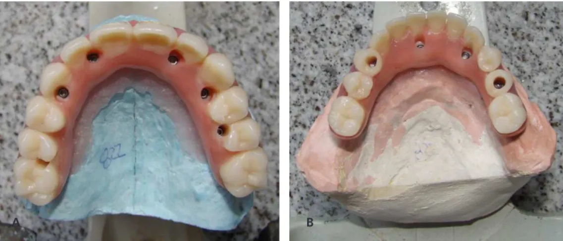 Figure 4.  Extention of the maxillary and mandibular cantilevers, respectively, not exceeding 15 mm