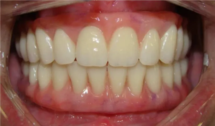 Figure 6.  Complete dentures ixed on angulated implants, restoring aesthetics and  masticatory function