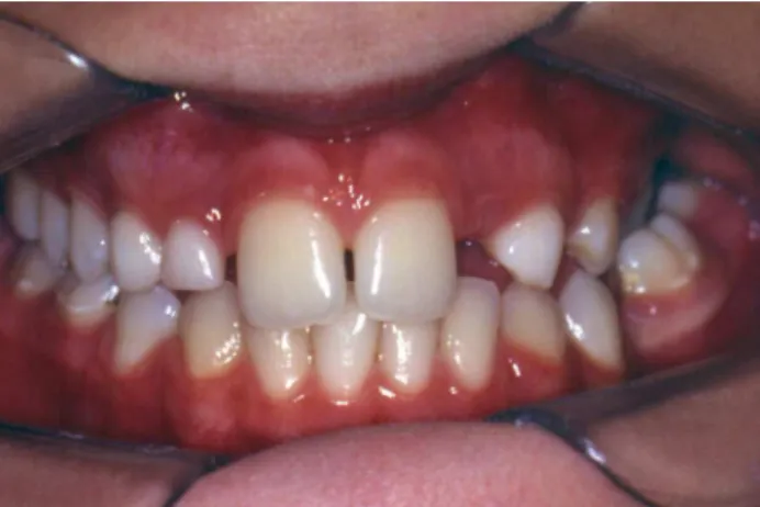 Figure 2.    Panoramic radiograph conirming absence of the permanent maxillary lat- lat-eral incisors, presence of a supernumerary tooth in the region of the right  maxillary lateral incisor, and absence of the mandibular second premolars.