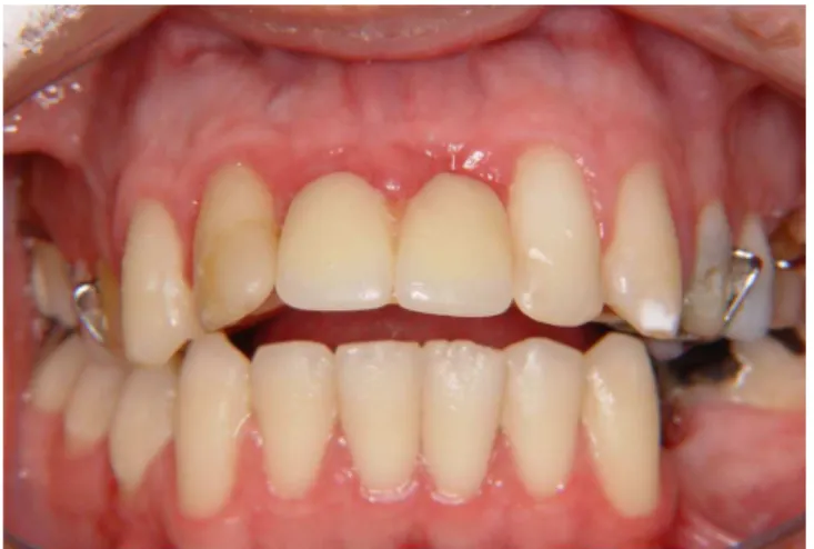 Figure 1. Temporary removable partial denture with compromised esthetics.  