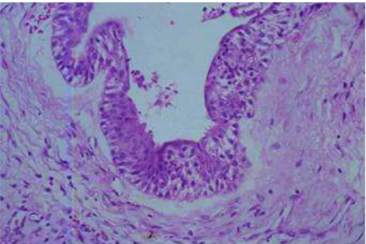 Figure 3.  Hematoxylin-eosin stain histological aspect in 10x magniication showing  multiple cystic areas (*).