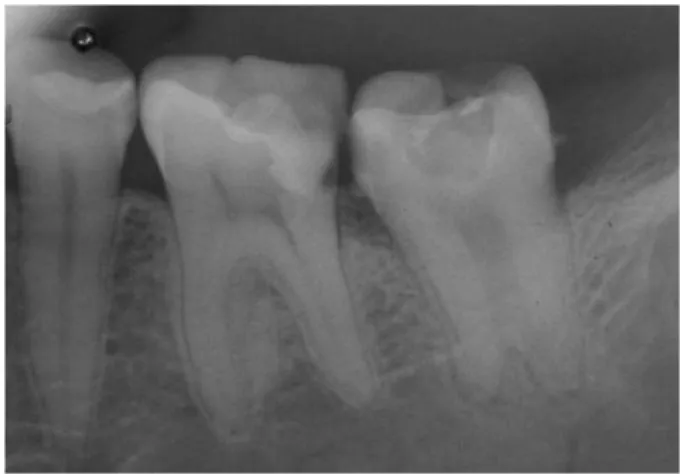 Figure 2.  First radiograph.  
