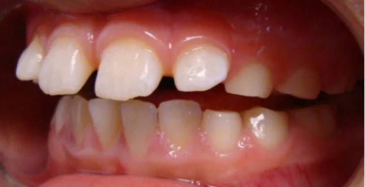 Figure 2. Lateral view (left) showing the wear facets.