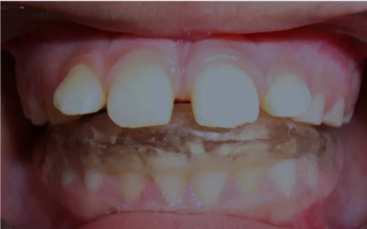 Figure 6. Occlusal splint in position.  