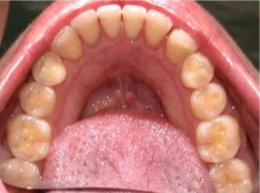 Figure 3. Aspect of erosion observed in the posterior teeth with loss of vertical  dimension.