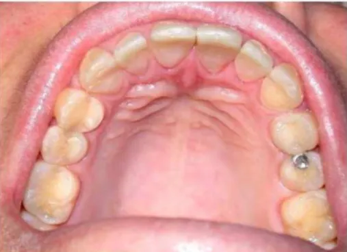 Figure 4. Finalized clinical case, with recovery of vertical dimension.  