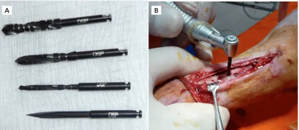 Figure 1.  A) Cutters with carbon coating (DSP Biomedical ® ) of conventional rotary system; B) Rotary cutting sequence in action using a system of cooling and the presence  of controlled bleeding during drilling.