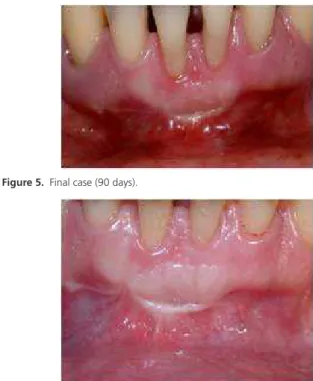 Figure 4.  Immediate post-operative case.