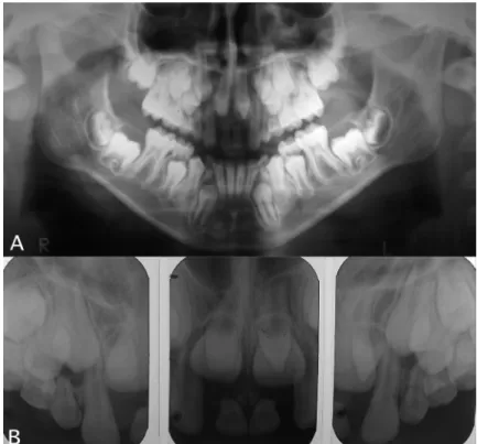 Figure 3.  A) initial panoramic x-ray; B) initial periapical location.